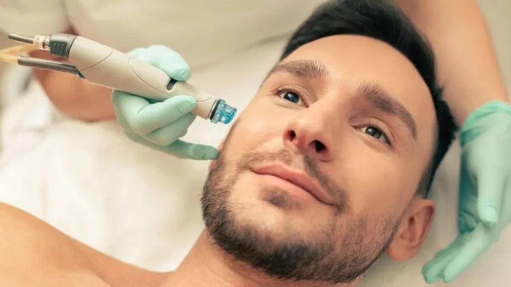 Microneedling with RF