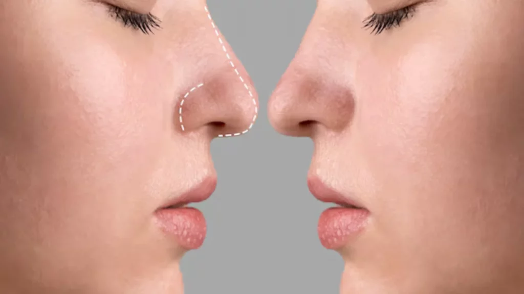 What is non Surgical Rhinoplasty