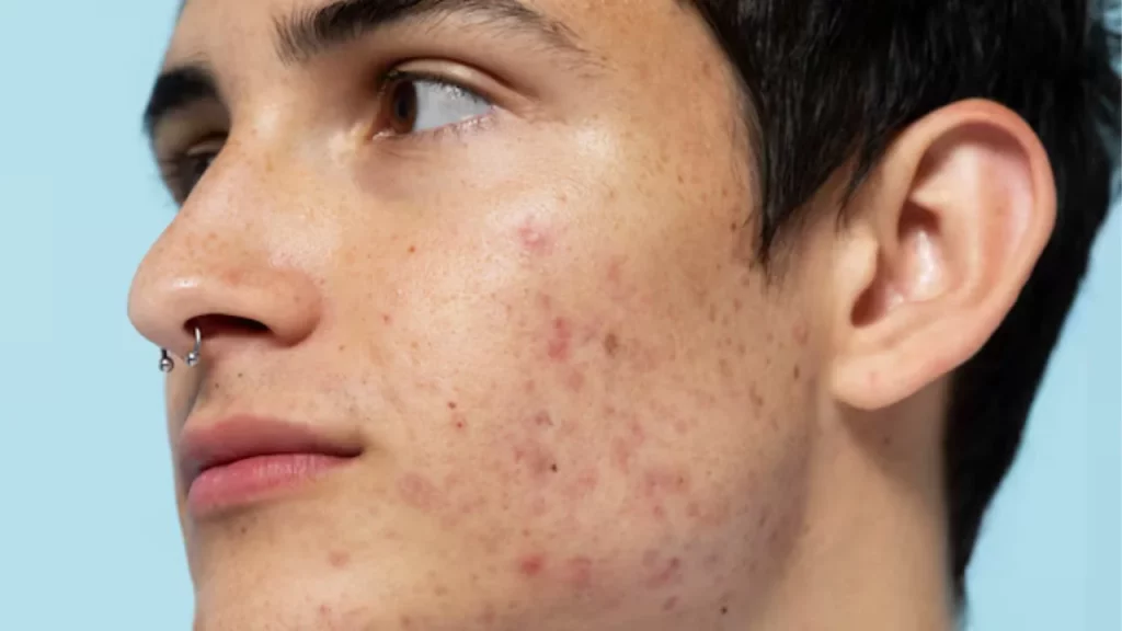 What is Acne and Why Do People Avoid Accutane?