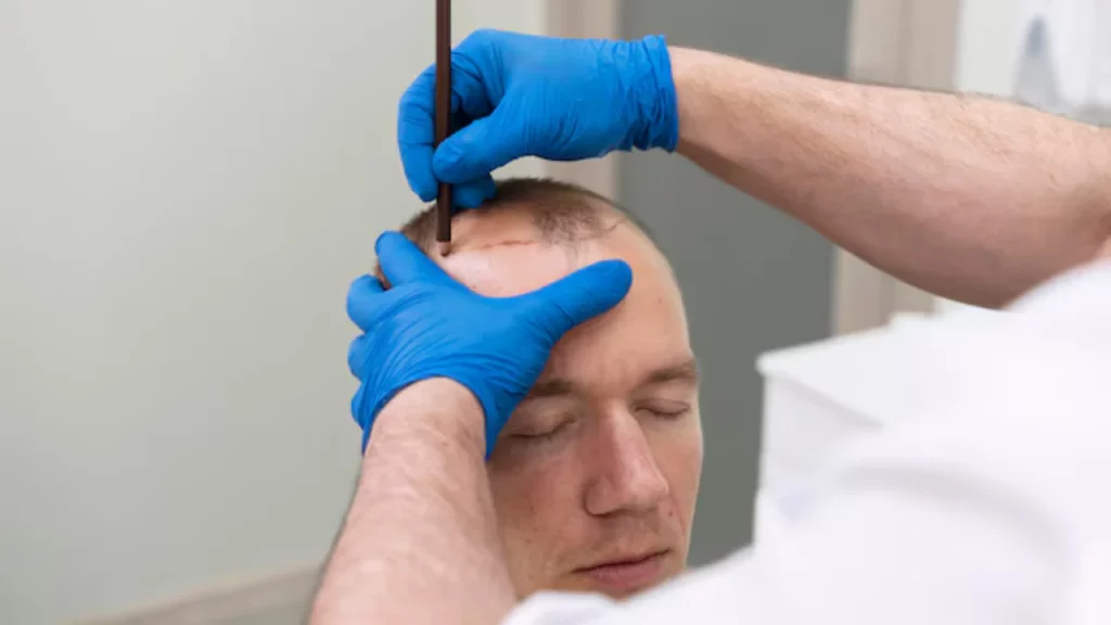 procedure of stem cell hair restoration